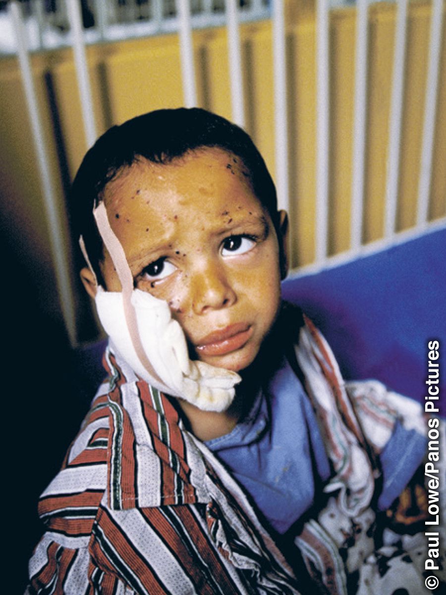 Ein kleiner Junge im Krankenhaus mit einem Verband im Gesicht