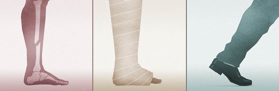 Keterangan Gambar: 1. Hasil rontgen tulang kaki yang patah. 2. Kaki yang dipasang gips. 3. Seorang pria berjalan 1.