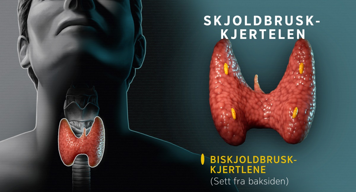 Bildeserie: Illustrasjoner av skjoldbruskkjertelen. 1. Et bilde som viser hvor skjoldbruskkjertelen er plassert, sett forfra. 2. Et bilde som viser skjoldbruskkjertelen bakfra, hvor man også ser biskjoldbruskkjertlene.